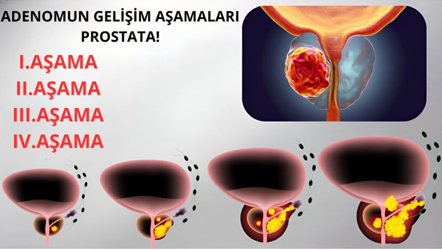 prostat için birebir tek tablet